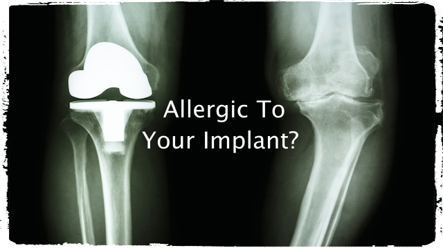 If You're Allergic to Metal Implants You Could Be at Risk for Skin Cancer