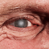 By Age 80 Half of All North Americans Will Deal with Cataracts