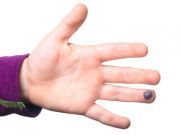 The Do’s and Don’ts of Blood Blisters