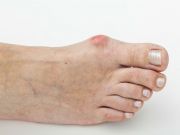 5 Common Foot Problems and What to do About Them