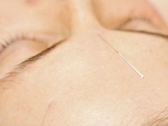 Cosmetic Acupuncture: Is It A Safe Alternative to Botox?