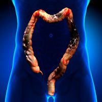 Colon Cancer / Colorectal cancer