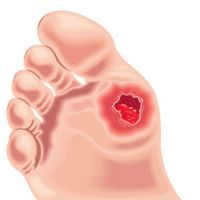Piede diabetico