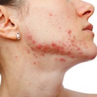 Young girl with skin problem