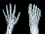 Do You Have Fat Bones?