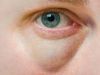 Puffy Eye Remedies: What Works, What Doesn’t Work