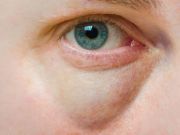 Puffy Eye Remedies: What Works, What Doesn’t Work