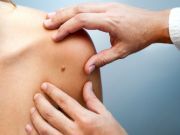When To Be Concerned About Your Moles