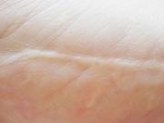 Natural Scar-Removing Remedies that Work