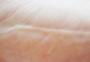 scar on skin