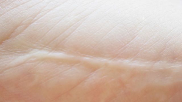 scar on skin