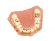 Are Your Mercury Fillings Causing Candida?