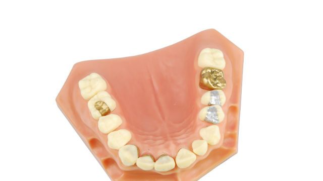 Dental model (with different treatments)