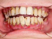 Want to Destroy Your Teeth? Do these 12 Things