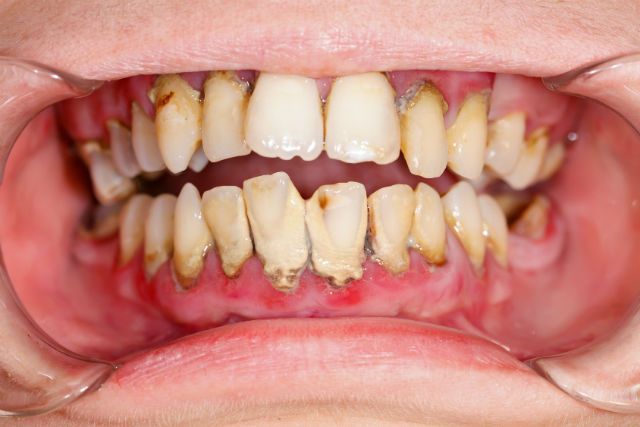 Want to Destroy Your Teeth? Do these 12 Things
