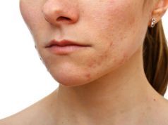 Can’t Sleep or Having a Breakout? What Your Hormones are Trying to Tell You