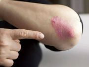 Natural Ways to Tackle Psoriasis