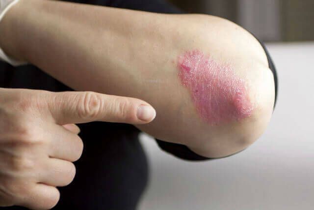 Natural Ways to Tackle Psoriasis