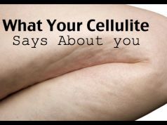 What Your Cellulite Says About Your Health
