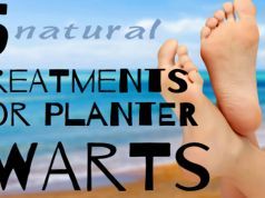 How and Why to Treat Plantar Warts Naturally (5 Ways)