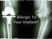 If You’re Allergic to Metal Implants You Could Be at Risk for Skin Cancer
