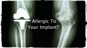 allergic implant