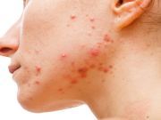 Natural Solutions for Your Teen’s Acne