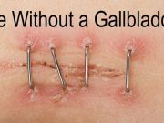How to Live Well Without Your Gallbladder