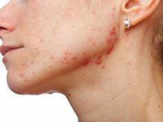 Rosacea: It’s More Than Just a Red Flush to Your Face