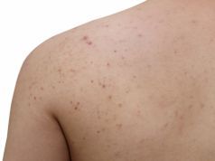 Got Body Acne? Natural Ways to Fix It