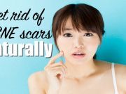 12 Things That Make Acne Scars Disappear Naturally