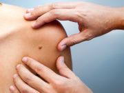 Absence of Moles Results in More Aggressive Skin Cancer, Study Finds