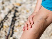 How to Prevent and Reverse Spider Veins and Varicose Veins