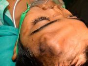Doctors Grow New Nose On Boy’s Forehead