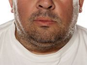 Hate Your Double Chin? Try These 7 Easy Home Remedies
