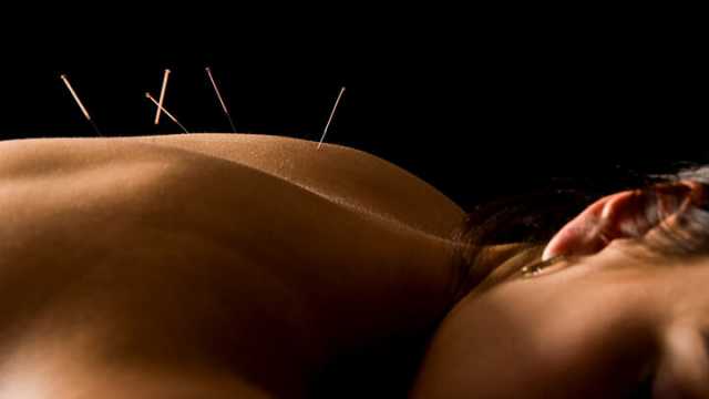 Acupuncture