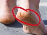 Say Goodbye To Cracked Heels For Good With This Soothing Remedy