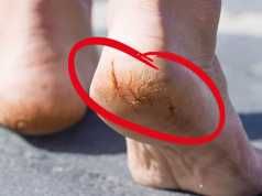 Say Goodbye To Cracked Heels For Good With This Soothing Remedy