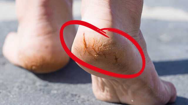 Get rid of cracked heels with this natural remedy
