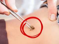 Health Benefits Of Bee Sting Therapy