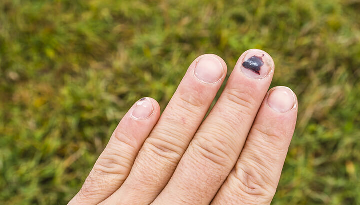 Black nails are normally harmless and go away on their own.