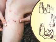 Heal Your Skin Naturally With This DIY Antifungal Cream