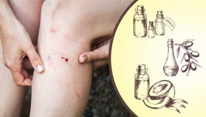 Heal Your Skin Naturally With This DIY Antifungal Cream