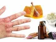 Heal Your Eczema With This Natural Moisturizing Lotion