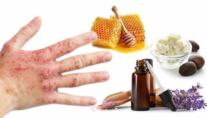 Heal Your Eczema With This Natural Moisturizing Lotion