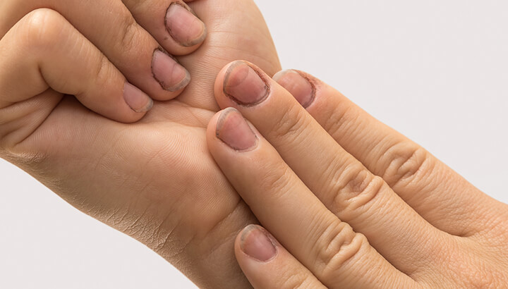 Horizontal fingernail lines could be a sign of a chronic disease.