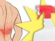 Relieve Itching And Pain FAST With This Homemade Shingles Spray