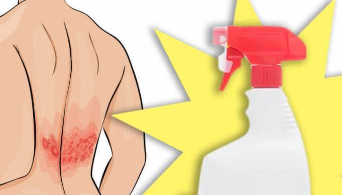 Relieve Itching And Pain FAST With This Homemade Shingles Spray
