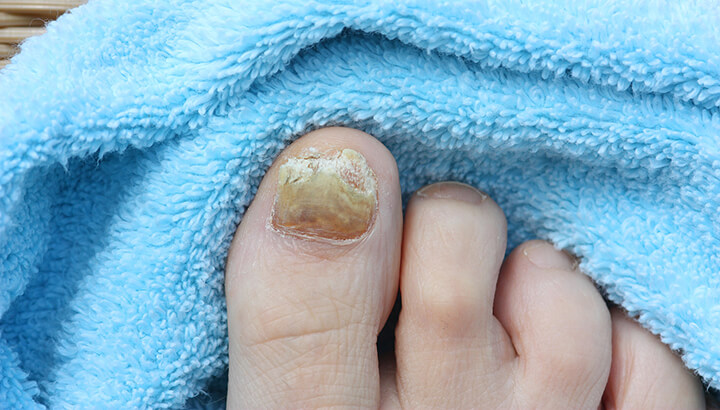 Yellow nails could be a sign of infection.