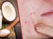 Whip Up This Potent Zit-Zapper Salve For Quick Relief